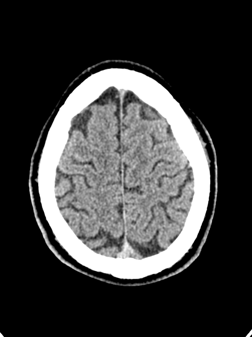 Normal trauma protocol brain and C-spine CT (Radiopaedia 83302-97709 Axial non-contrast 19).jpg