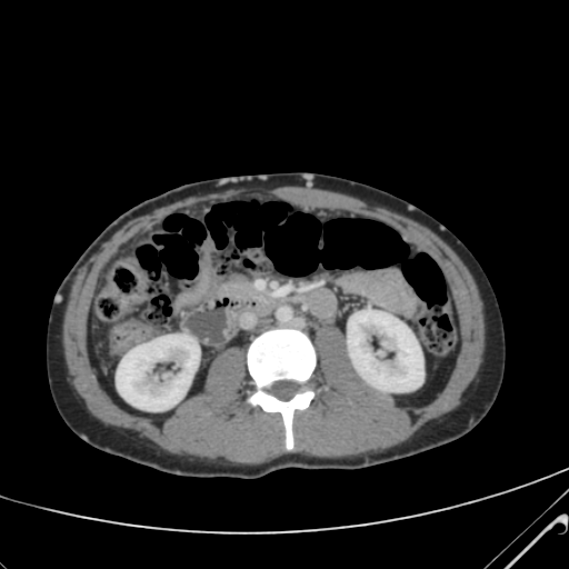 File:Nutmeg liver- Budd-Chiari syndrome (Radiopaedia 46234-50635 B 31).png