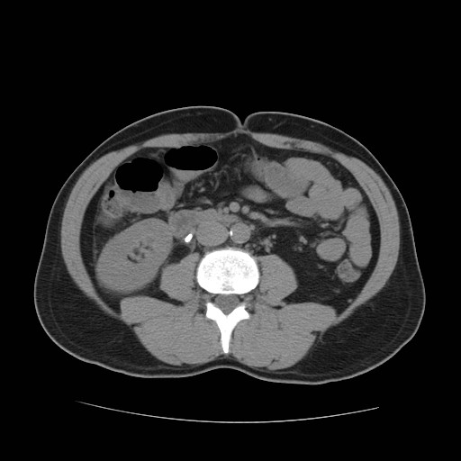 File:Obstructed kidney with perinephric urinoma (Radiopaedia 26889-27067 Axial non-contrast 18).jpg