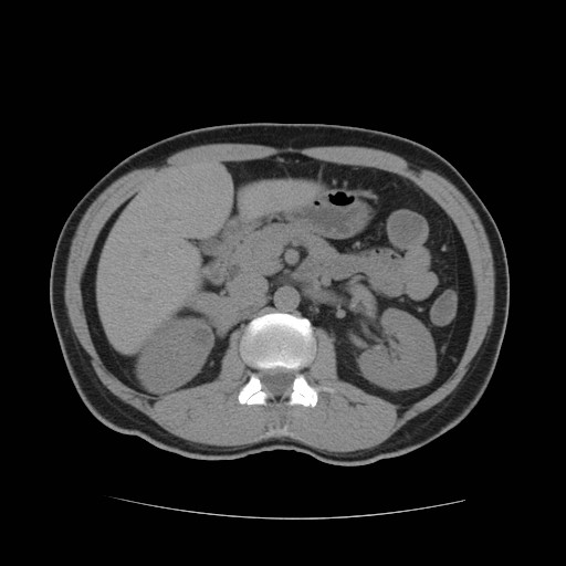 File:Obstructed kidney with perinephric urinoma (Radiopaedia 26889-27067 Axial non-contrast 7).jpg
