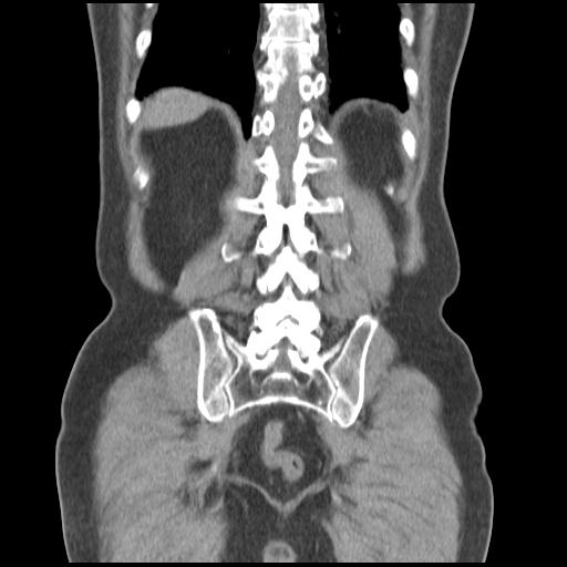 Obstructing renal calculus (Radiopaedia 29517-30016 Coronal non-contrast 43).jpg