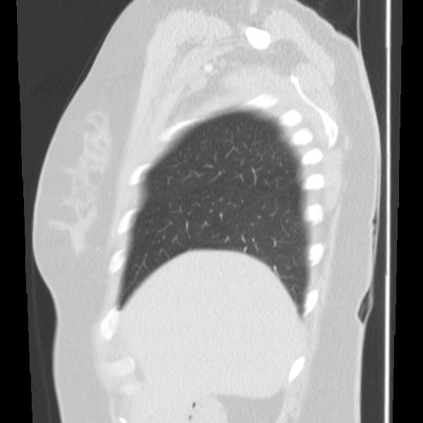 Obstructing typical carcinoid causing bronchoceles (Radiopaedia 50149-55476 Sagittal lung window 10).png