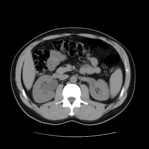 File:Obstructing ureteric calculus (Radiopaedia 18615-18514 Axial non-contrast 23).jpg