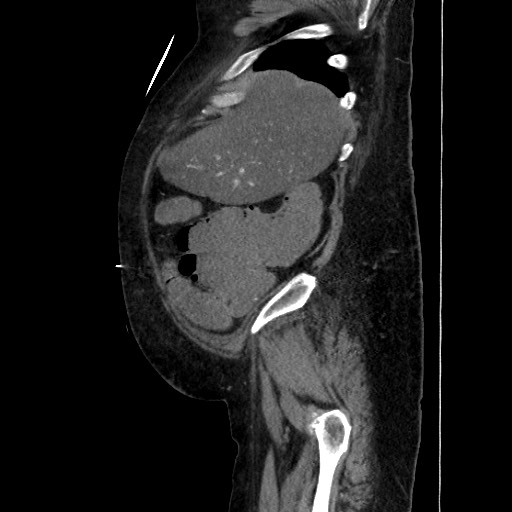 Obstructive colonic diverticular stricture (Radiopaedia 81085-94675 C 51).jpg