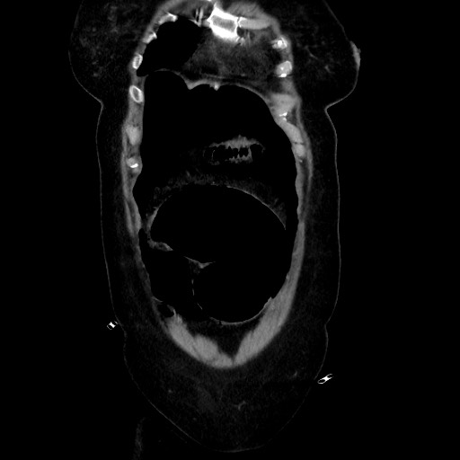 Obstructive distal colonic adenocarcinoma causing cecal perforation (Radiopaedia 86830-102989 C 52).jpg