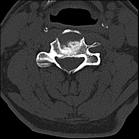 Occipital condyle fracture (type 1) (Radiopaedia 87670-104084 Axial bone window 46).jpg