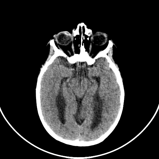 Occipital encephalocele (Radiopaedia 87339-103636 Axial non-contrast 35).jpg