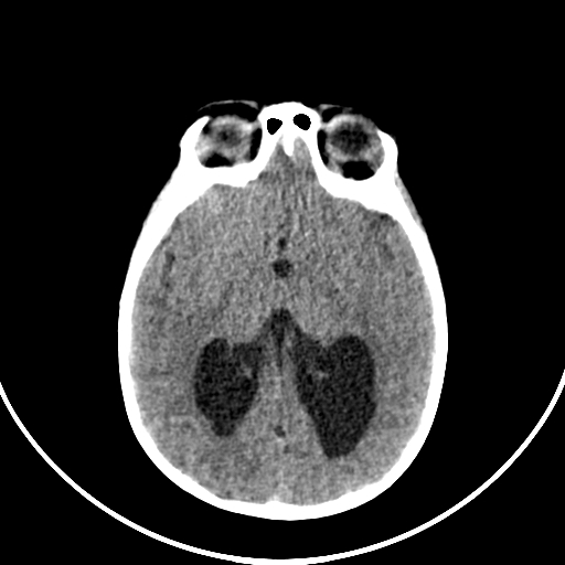 Occipital encephalocele (Radiopaedia 87339-103636 Axial non-contrast 42).jpg