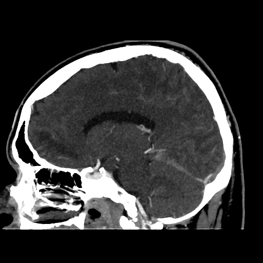 Occipital extradural hematoma simulating venous sinus thrombosis (Radiopaedia 46514-50964 D 34).jpg