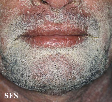 File:Psoriasis (Dermatology Atlas 54).jpg