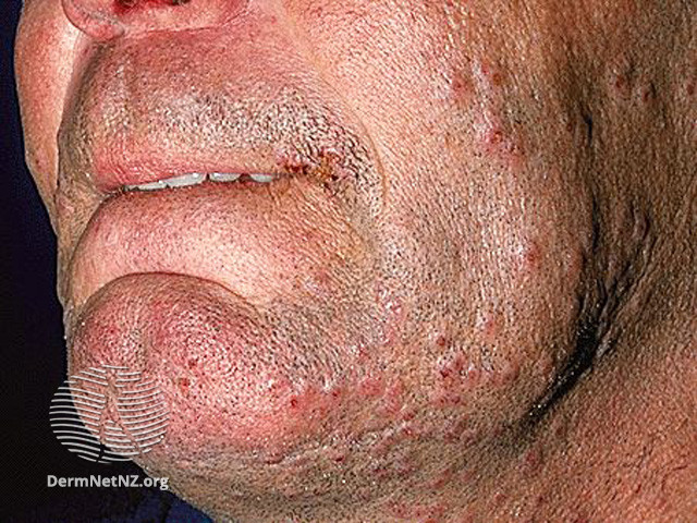 File:(DermNet NZ acne-folliculitis-2653).jpg