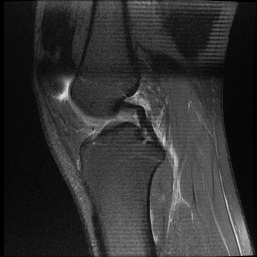 File:ACL acute full thickness tear - deep lateral femoral sulcus sign (Radiopaedia 38594-40740 Sagittal PD fat sat 10).jpg