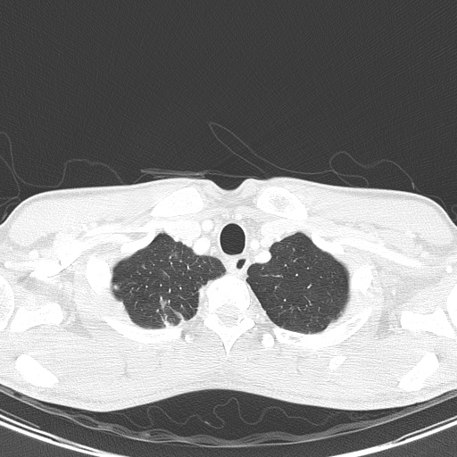 AIDS-related Kaposi sarcoma (Radiopaedia 85247-100811 Axial lung window 15).jpg