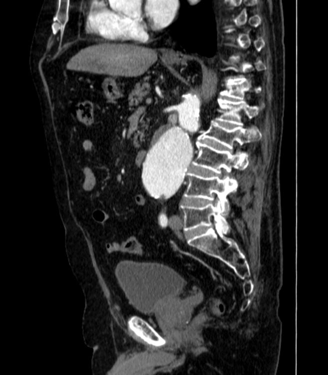 Abdominal aortic aneurysm (Radiopaedia 25855-26001 Sagittal C+ arterial phase 31).jpg