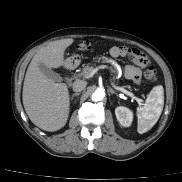Abdominal aortic aneurysm (Radiopaedia 29248-29660 Axial C+ arterial phase 28).jpg