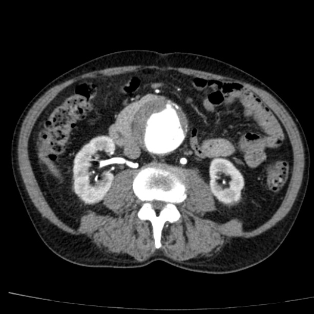 Abdominal aortic aneurysm (Radiopaedia 29248-29660 Axial C+ arterial phase 43).jpg