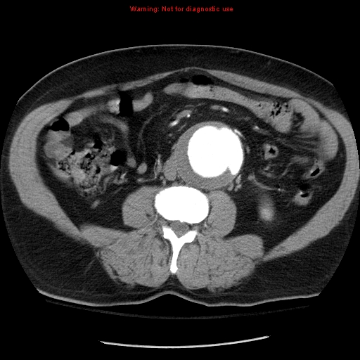 Abdominal aortic aneurysm (Radiopaedia 8190-9038 Axial C+ arterial phase 44).jpg