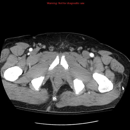 Abdominal aortic aneurysm (Radiopaedia 8190-9038 Axial C+ arterial phase 87).jpg