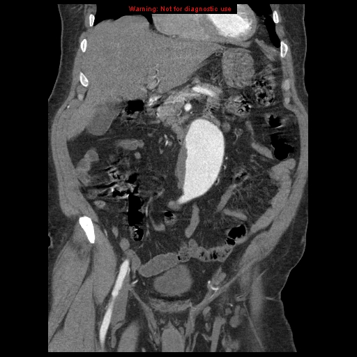File:Abdominal aortic aneurysm (Radiopaedia 8190-9038 Coronal C+ arterial phase 44).jpg