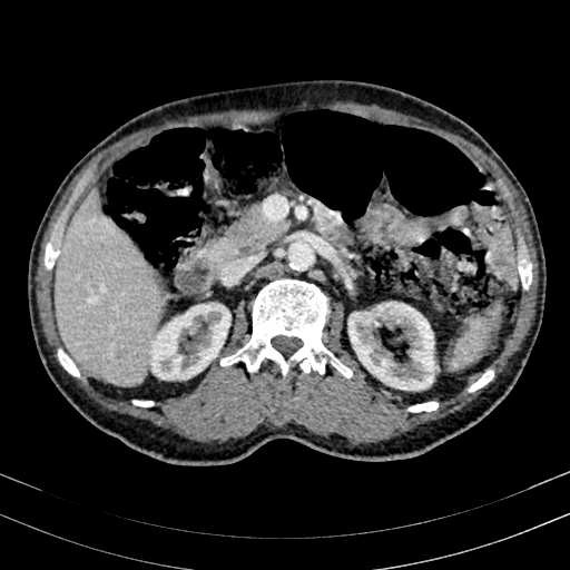 Abdominal aortic aneurysm (Radiopaedia 83581-98689 Axial C+ portal venous phase 43).jpg