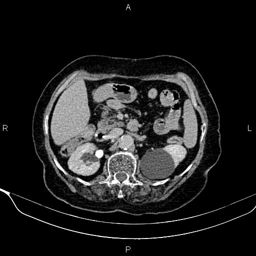 Abdominal aortic aneurysm (Radiopaedia 85063-100606 Axial C+ delayed 36).jpg