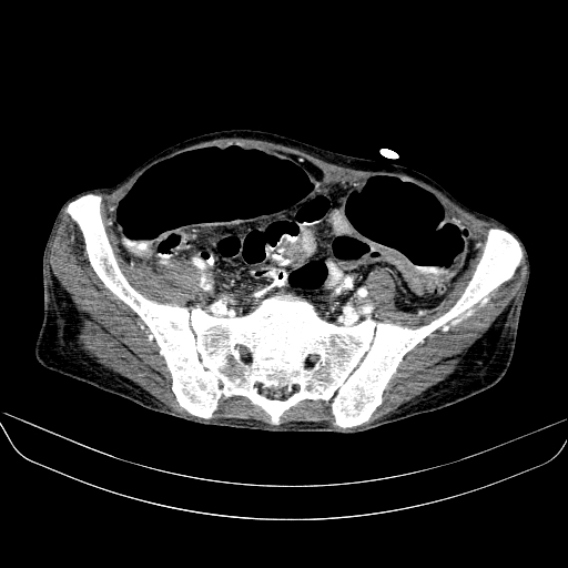 File:Abdominal collection due to previous cecal perforation (Radiopaedia 80831-94320 Axial C+ portal venous phase 157).jpg