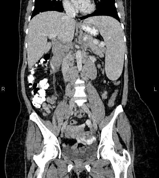 Abdominal lymphoma with sandwich sign (Radiopaedia 84378-99704 Coronal C+ portal venous phase 33).jpg