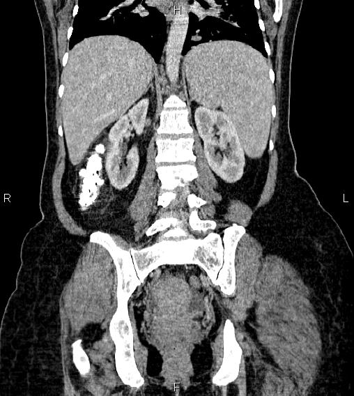 Abdominal lymphoma with sandwich sign (Radiopaedia 84378-99704 Coronal C+ portal venous phase 45).jpg