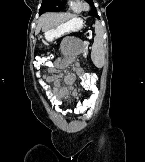Abdominal lymphoma with sandwich sign (Radiopaedia 84378-99704 Coronal C+ portal venous phase 8).jpg