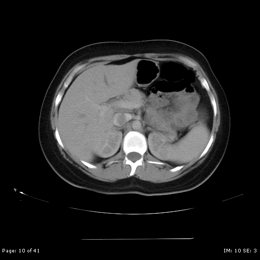File:Abdominal wall endometriosis (Radiopaedia 25723-25885 Axial C+ portal venous phase 10).jpg