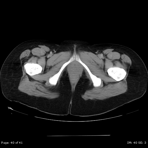 File:Abdominal wall endometriosis (Radiopaedia 25723-25885 Axial C+ portal venous phase 40).jpg