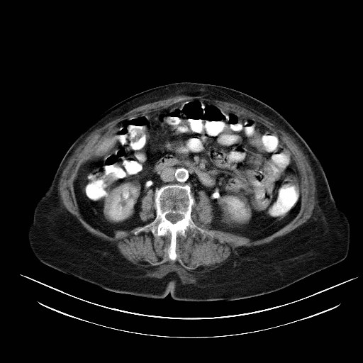 File:Abdominal wall recurrence after colorectal resection for cancer (Radiopaedia 23444-23523 Axial C+ portal venous phase 15).jpg