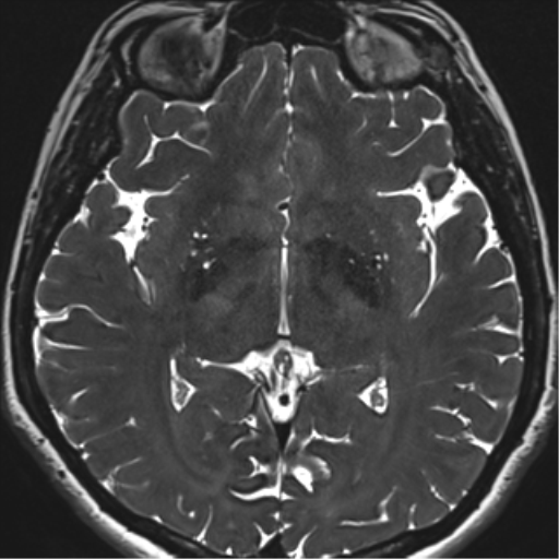 Abducens nerve palsy (Radiopaedia 51069-56648 Axial T2 fat sat 88).png