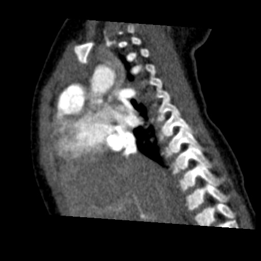File:Aberrant left pulmonary artery (pulmonary sling) (Radiopaedia 42323-45435 Sagittal C+ arterial phase 23).jpg