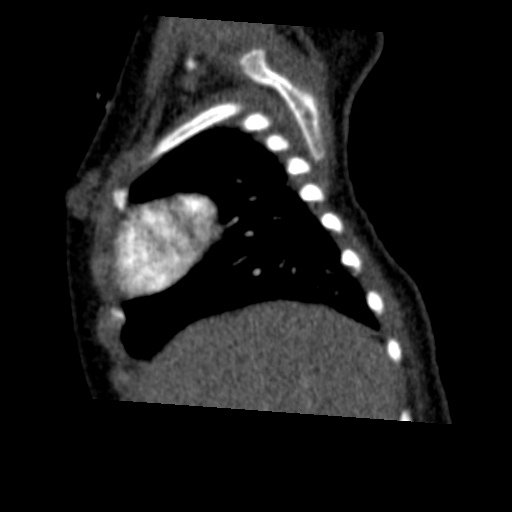 Aberrant left pulmonary artery (pulmonary sling) (Radiopaedia 42323-45435 Sagittal C+ arterial phase 9).jpg