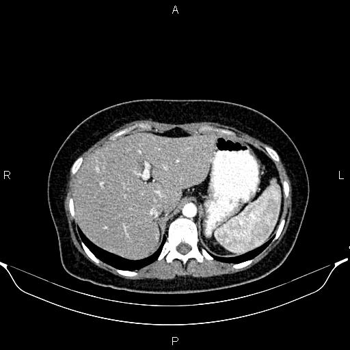 File:Aberrant right subclavian artery (Radiopaedia 87334-103629 Axial C+ arterial phase 63).jpg