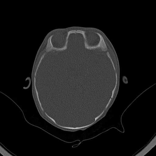 File:Accessory intraparietal suture (Radiopaedia 50584-56020 Axial bone window 15).jpg