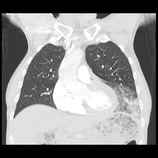 Accessory left horizontal fissure with lingular pneumonia (Radiopaedia 53763-59843 Coronal lung window 17).jpg