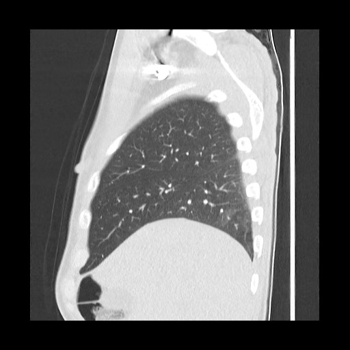 Accessory left horizontal fissure with lingular pneumonia (Radiopaedia 53763-59843 Sagittal lung window 16).jpg