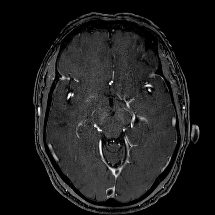Accessory middle cerebral artery (Radiopaedia 73114-83828 Axial MRA 82).jpg