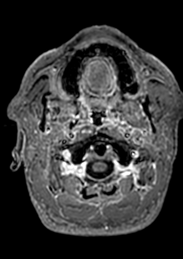 Accessory middle cerebral artery (Radiopaedia 73114-83828 Axial T1 C+ 210).jpg