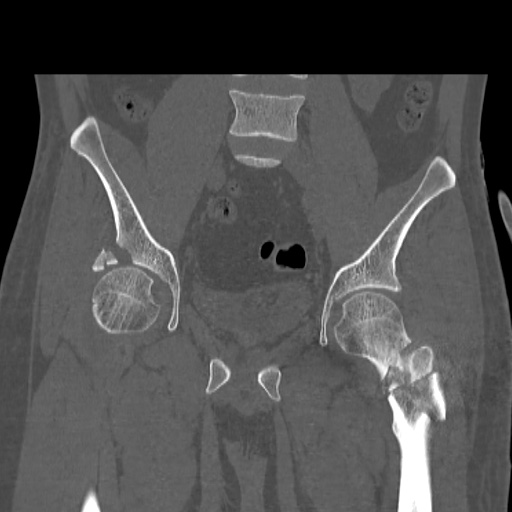 File:Acetabular and ilial fractures (Radiopaedia 59084-66378 Coronal bone window 24).jpg