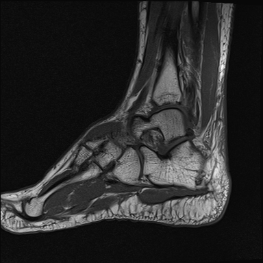 File:Achilles tendon tear (Radiopaedia 77615-89819 Sagittal T1 15).jpg