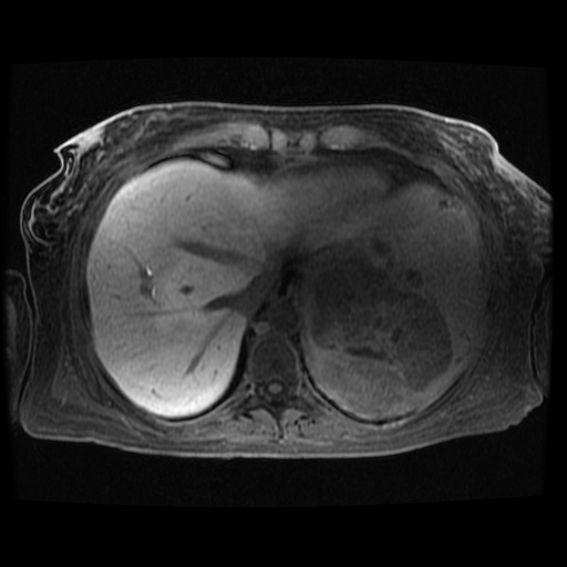 Acinar cell carcinoma of the pancreas (Radiopaedia 75442-86668 Axial late phase (~30 mins) 121).jpg