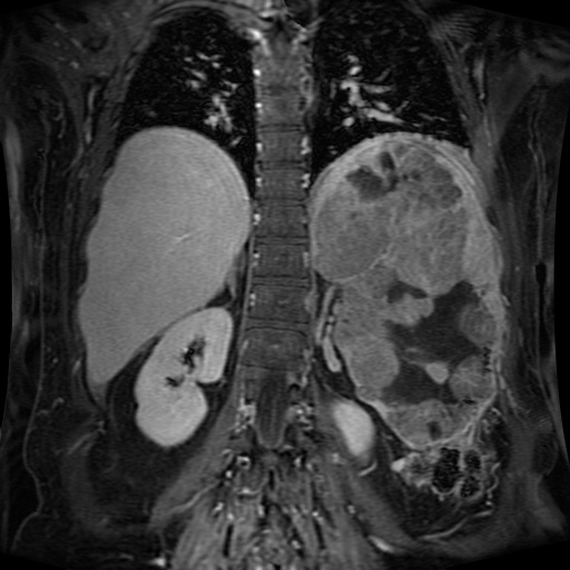 Acinar cell carcinoma of the pancreas (Radiopaedia 75442-86668 Coronal T1 C+ fat sat 62).jpg