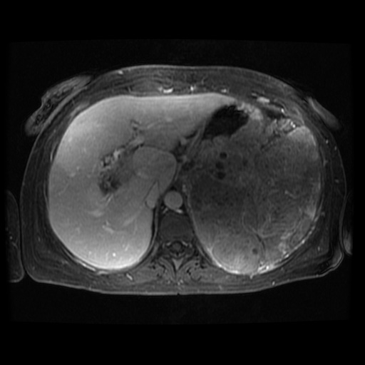 Acinar cell carcinoma of the pancreas (Radiopaedia 75442-86668 D 100).jpg
