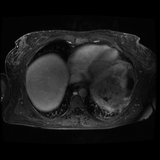 Acinar cell carcinoma of the pancreas (Radiopaedia 75442-86668 D 133).jpg
