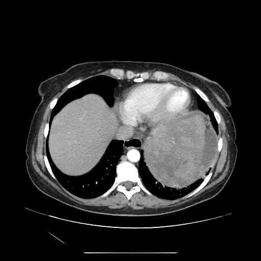 Acinar cell carcinoma of the pancreas (Radiopaedia 75442-86669 Axial C+ portal venous phase 11).jpg