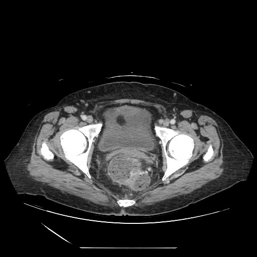 Acinar cell carcinoma of the pancreas (Radiopaedia 75442-86669 Axial C+ portal venous phase 139).jpg