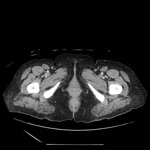File:Acinar cell carcinoma of the pancreas (Radiopaedia 75442-86669 Axial C+ portal venous phase 159).jpg